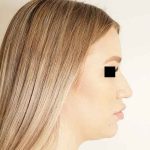 Rhinoplasty Before & After Patient #296