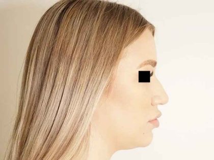 Rhinoplasty Before & After Patient #296