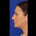 Rhinoplasty Before & After Patient #299