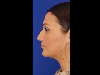 Rhinoplasty Before & After Patient #299