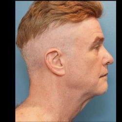 Necklift Before & After Patient #304