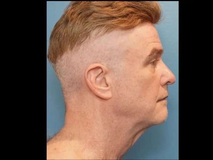 Necklift Before & After Patient #304