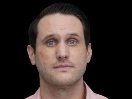 Rhinoplasty Before & After Patient #260