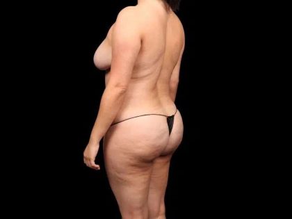 Brazilian Butt Lift Before & After Patient #330