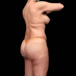 Brazilian Butt Lift Before & After Patient #335