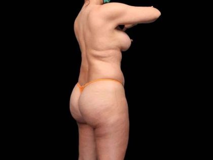 Brazilian Butt Lift Before & After Patient #335