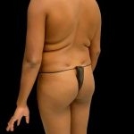 Brazilian Butt Lift Before & After Patient #343