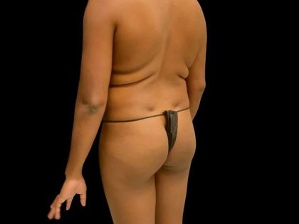Brazilian Butt Lift Before & After Patient #343