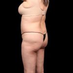 Brazilian Butt Lift Before & After Patient #350