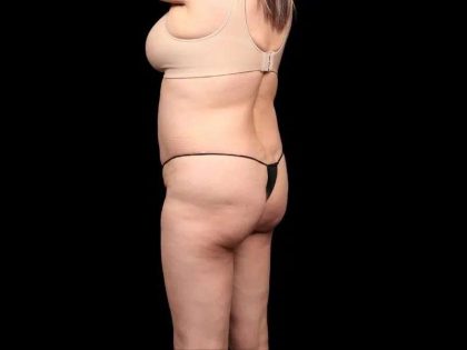 Brazilian Butt Lift Before & After Patient #350