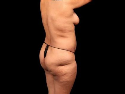 Brazilian Butt Lift Before & After Patient #355