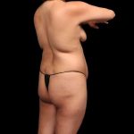 Brazilian Butt Lift Before & After Patient #362