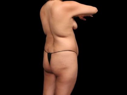Brazilian Butt Lift Before & After Patient #362