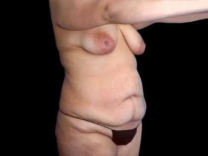 Tummy Tuck Before & After Patient #379