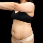 Tummy Tuck Before & After Patient #407