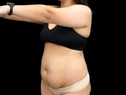 Tummy Tuck Before & After Patient #407