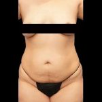 Tummy Tuck Before & After Patient #412