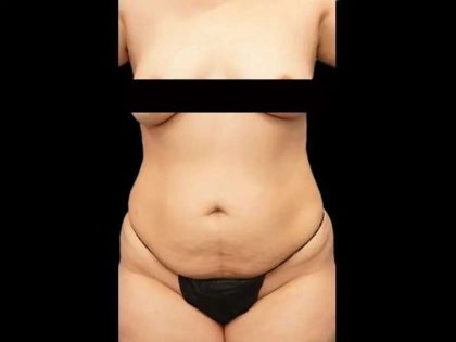 Tummy Tuck Before & After Patient #412