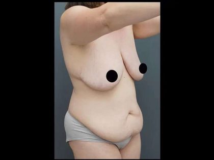 Tummy Tuck Before & After Patient #417