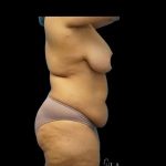 Tummy Tuck Before & After Patient #422