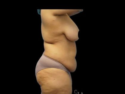 Tummy Tuck Before & After Patient #422