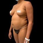 Liposuction Before & After Patient #434