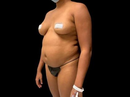Liposuction Before & After Patient #434