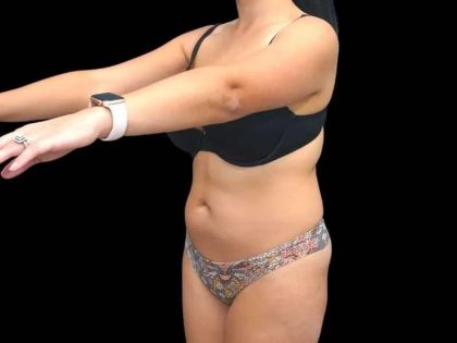 Liposuction Before & After Patient #451