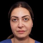 Rhinoplasty Before & After Patient #274