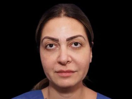 Rhinoplasty Before & After Patient #274