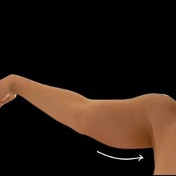 Liposuction Before & After Patient #610
