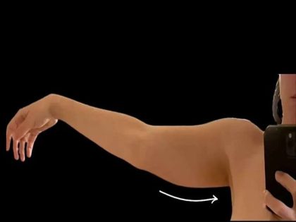 Liposuction Before & After Patient #610