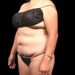Mommy Makeover Before & After Patient #478