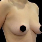Breast Augmentation Before & After Patient #499
