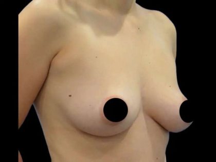 Breast Augmentation Before & After Patient #499