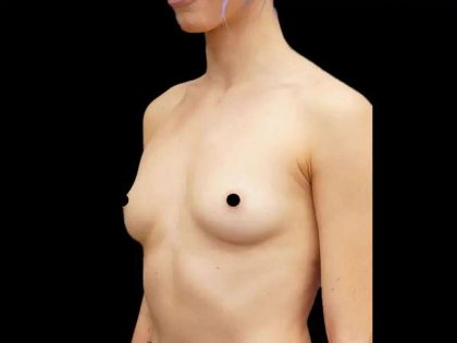 Breast Augmentation Before & After Patient #513