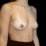 Breast Augmentation Before & After Patient #546