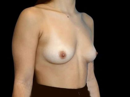 Breast Augmentation Before & After Patient #546