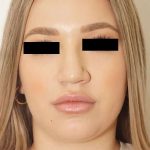 Rhinoplasty Before & After Patient #296