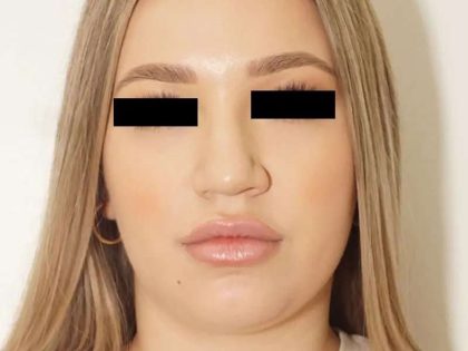 Rhinoplasty Before & After Patient #296