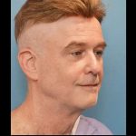 Necklift Before & After Patient #304