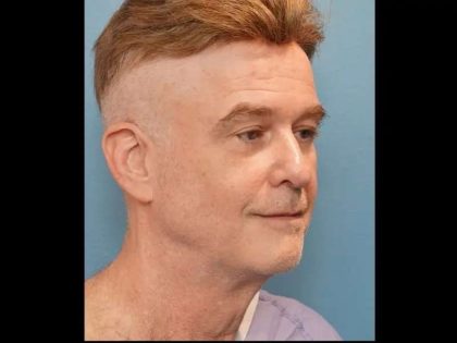 Necklift Before & After Patient #304