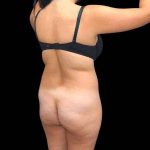 Brazilian Butt Lift Before & After Patient #311