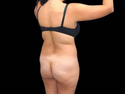 Brazilian Butt Lift Before & After Patient #311