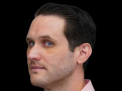 Rhinoplasty Before & After Patient #260