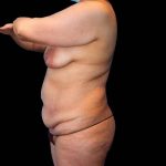 Tummy Tuck Before & After Patient #379