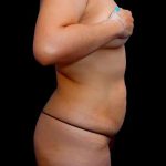 Tummy Tuck Before & After Patient #386