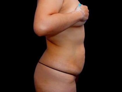 Tummy Tuck Before & After Patient #386