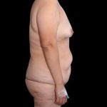 Tummy Tuck Before & After Patient #393