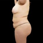 Tummy Tuck Before & After Patient #400